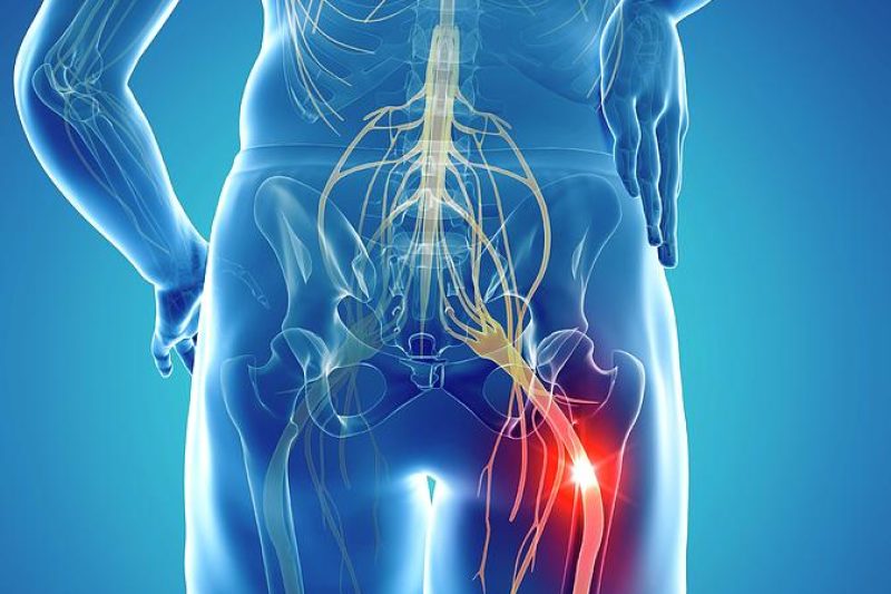 Sciatica Causes, Symptoms, and Effective Treatments