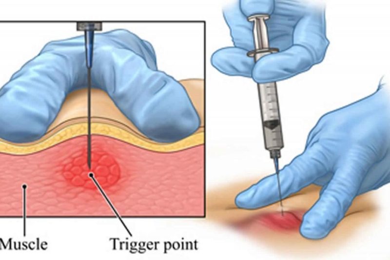 💉 Everything You Need to Know About Trigger Point Injections