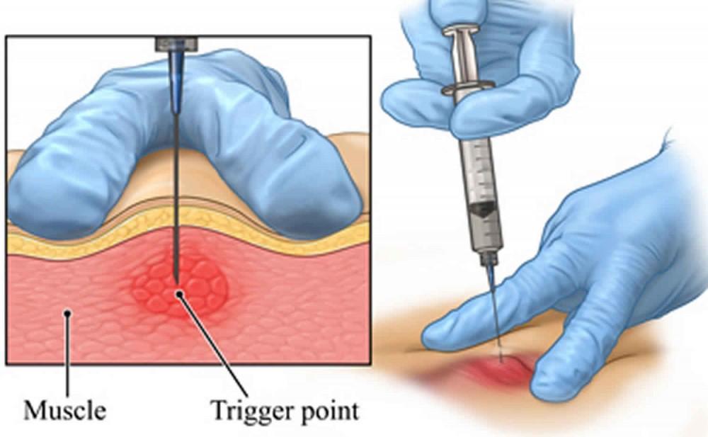 💉 Everything You Need to Know About Trigger Point Injections