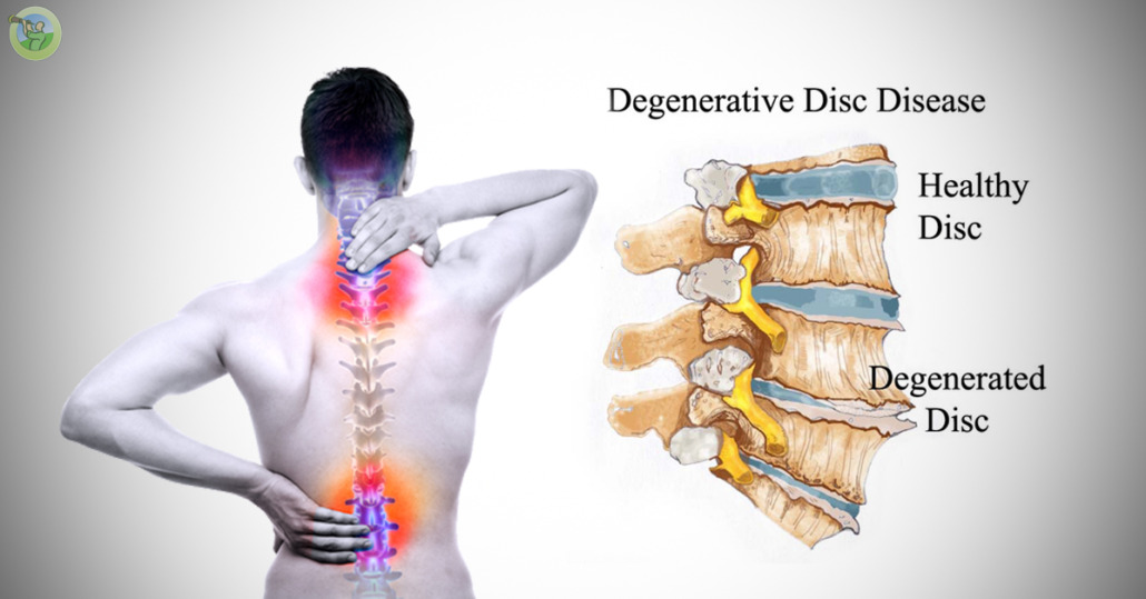 🧠 Understanding Degenerative Disc Disease Symptoms, Causes, and Modern Treatment Options