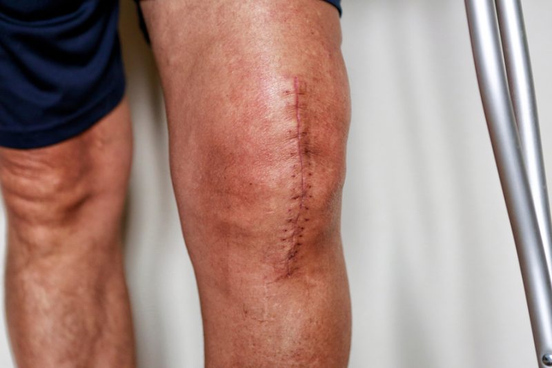 Can Regenerative Medicine Delay Joint Replacement?