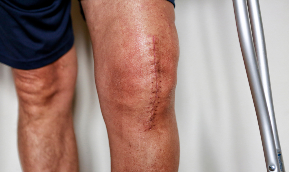 Can Regenerative Medicine Delay Joint Replacement?